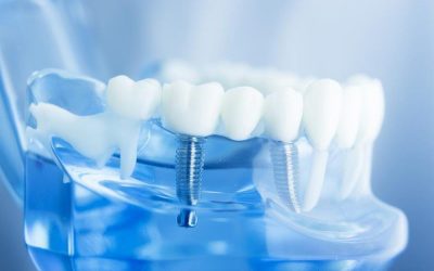 review-trong-rang-implant