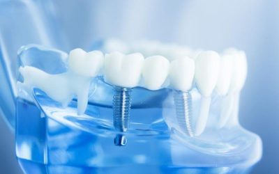 review-trong-rang-implant